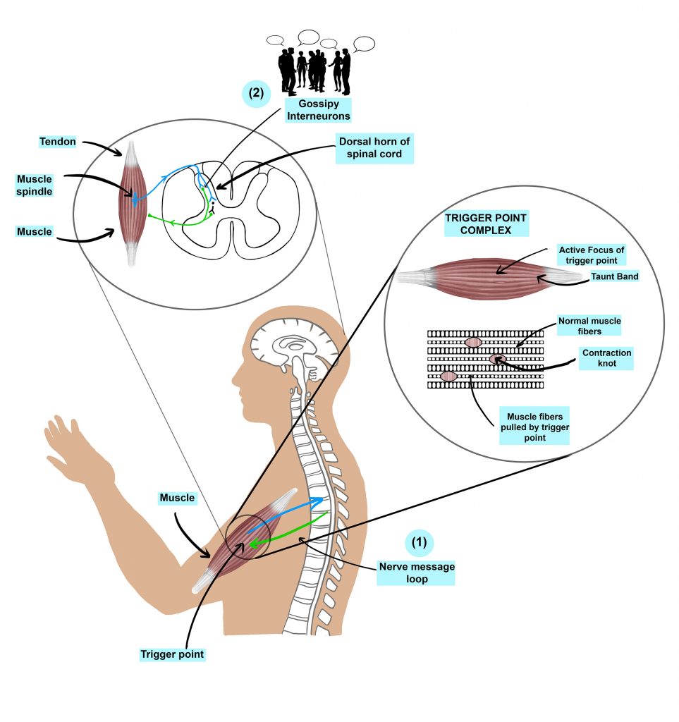 Myofascial Pain Syndrome vs Fibromyalgia