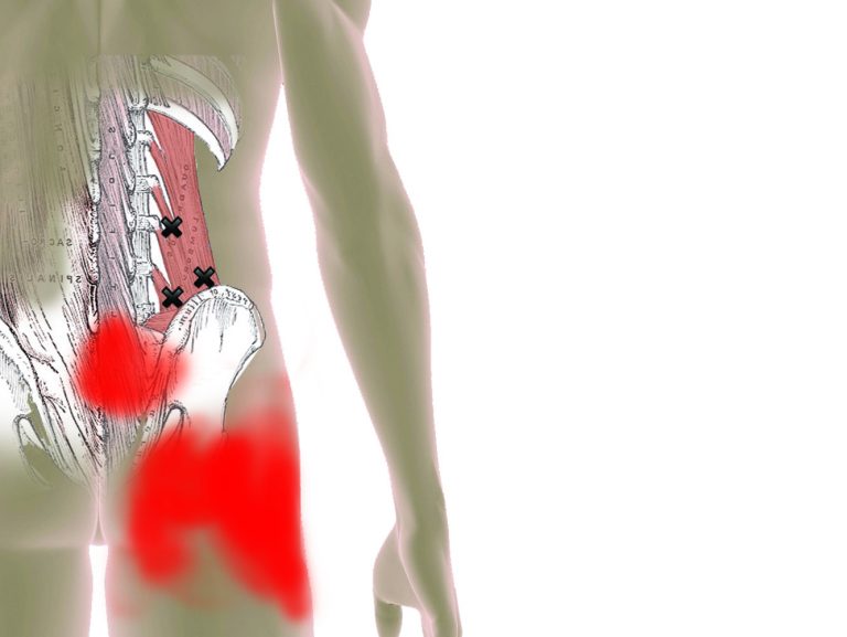Quadratus Lumborum Trigger Points and How to Treat Them