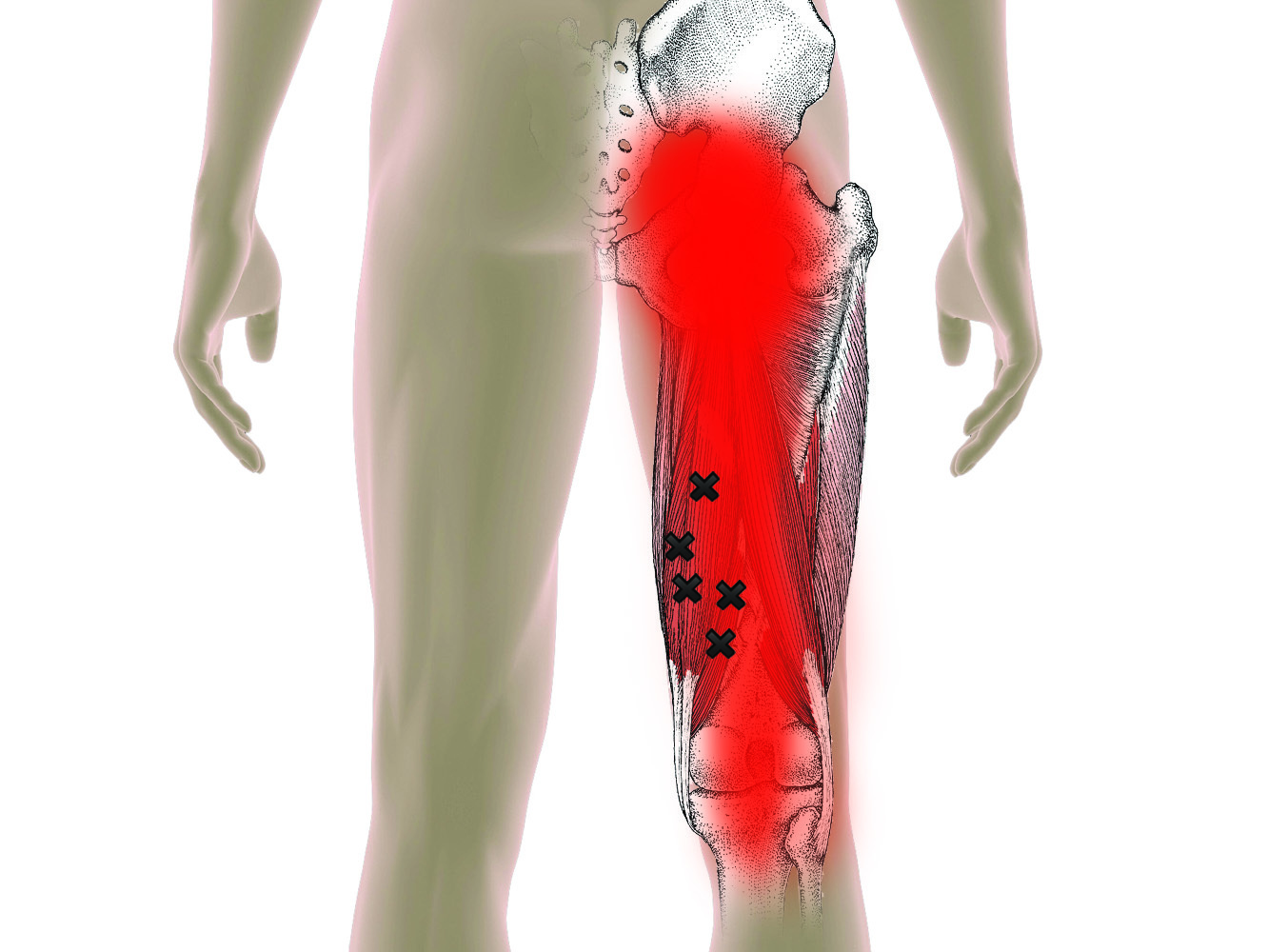 Hamstring Trigger Points