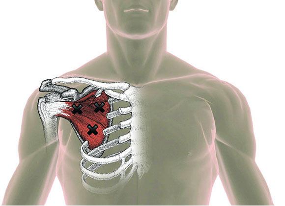 Subscapularis Trigger Points Overview Self Treatment Vrogue Co Subscapularis Trigger Points Overview Self Treatment Vrogue Co